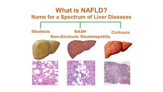 What is NonAlcoholic Fatty Liver Disease NAFLD [upl. by Yle]