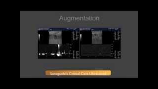 DVT Ultrasound Augmentation Technique [upl. by Canica]