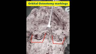 Facial Bipartition Surgery for Ocular Hypertelorism Correction at GSR Hospital Hyderabad India [upl. by Caiaphas]