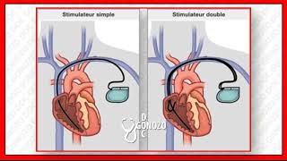 pleuropéricardite après implantation dun stimulateur cardiaque [upl. by Oiramrej]