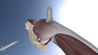 3D Model of Ultrasound Guided Greater Trochanteric Bursitis Injection by probeultrasound [upl. by Sama]