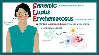 Systemic Lupus Erythematosus  signs and symptoms pathophysiology and diagnosis of Systemic Lupus [upl. by Assiron641]