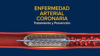 Enfermedad Arterial Coronaria EAC Tratamiento y prevención [upl. by Singhal59]