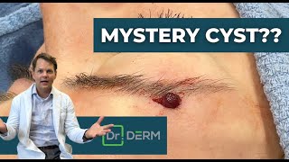 Mystery Cyst  Dr Derm [upl. by Mayer]