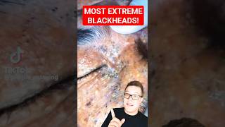 Shocking BLACKHEAD REMOVAL  Extreme Blackhead Extraction shorts [upl. by Bluh790]