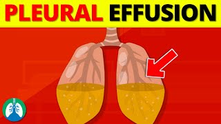 Pleural Effusion Medical Definition  Quick Explainer Video [upl. by Alegnat]