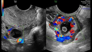 CORPUS LUTEUM VS ECTOPIC PREGNANCY [upl. by Truda]