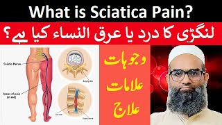 What is Sciatica Pain  Langri Ka Dard  Arqun Nisa  Causes Symptoms and Treatment  Urdu  Hindi [upl. by Debbee935]