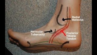 Posterior Tibial Tendinitis Evaluation with Paul Marquis PT [upl. by Perpetua]