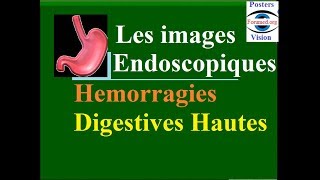 Les images endoscopiques et causes des hémorragies digestive hautes fibroscopie gastrique endoscopie [upl. by Idihc860]