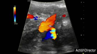 Obstetric Doppler ultrasound method of identifying the vessels [upl. by Hnib]