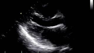 Constrictive Pericarditis Following Heart Transplant 1 [upl. by Elo]