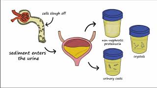 Analgesic Nephropathy AN Kidney Damage from NSAIDs [upl. by Jerol169]