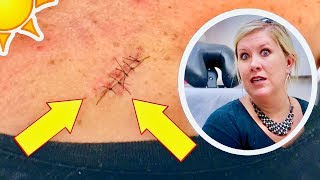 SKIN CANCER SURGERY 😧 Removing precancerous skin growth  5 stitches [upl. by Dawson559]