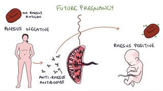 Understanding Rhesus Status and AntiD in Pregnancy [upl. by Anirbac38]