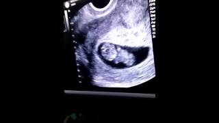 9 Weeks 4 Days Pregnant Ultrasound [upl. by Suirrad379]