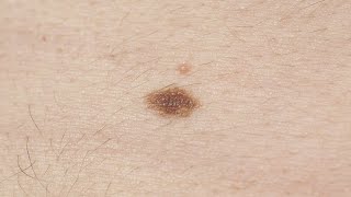 Melanoma symptoms How to spot signs and when to see a doctor [upl. by Columbyne]