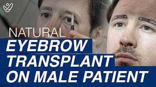 Eyebrow Transplant for MEN  Get the Perfect Eyebrows [upl. by Attenborough]