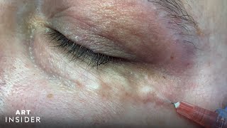 Carboxytherapy Helps Treat Dark UnderEyes [upl. by Nylevol999]