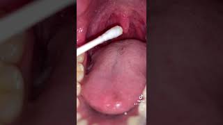 Unedited amp uncut Week 5 Tonsil stones removal and cleaning foryou viralvideo tiktok [upl. by Ennair799]