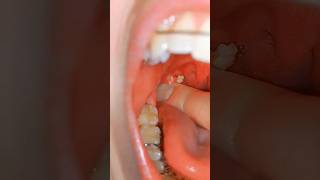 tonsil stones removal shorts tonsils tonsil stones removal [upl. by Anitnoc]