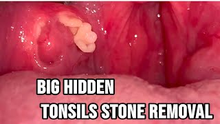 big hidden tonsils stones removal tonsilolith tonsils stones for educational purposes only [upl. by Lahey693]