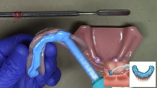 Laboratory Reline for LOCATOR and LOCATOR RTx Dentures StepByStep Technique [upl. by Econah]