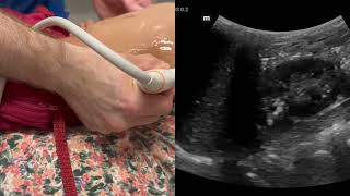 Pediatric RenalBladder Scan Demo L kidney long axis [upl. by Ransome]