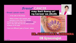 DUCTAL BREAST CANCER [upl. by Gannon]