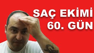 Saç ekimi  60 gün [upl. by Yrrap]