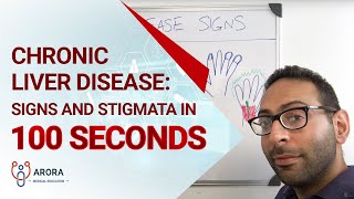 Chronic Liver Disease Signs and Stigmata in 100 seconds [upl. by Aij]