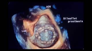 3Dview of cardiac prosthetic valves to drahmadmirdamadisiwlaQFIbeKfu1q [upl. by Nevart]