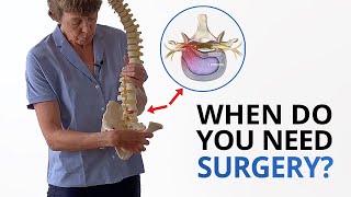 Disc Herniation When Do You Need Surgery PLUS Fixing the Root Cause [upl. by Errick137]