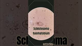 Schistosoma haematobium in urine  Clinical Parasitology [upl. by Llewen]