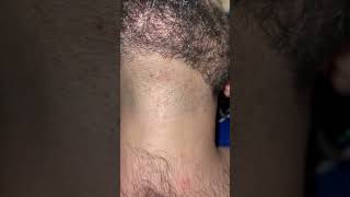 barber hairissue hair removingingrown hairproblem barbershop ingrownhair beard [upl. by Ehcsrop]