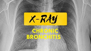 Things Found In An X Ray  Xray of Chest  Chronic Bronchitis On XRay [upl. by Eimiaj]