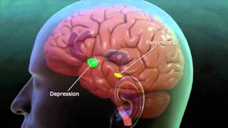 Deep Brain Stimulation explanation [upl. by Charlean]