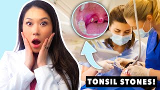 All About Tonsil Stones [upl. by Nathaniel]