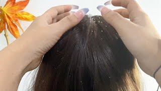 ASMR Dandruff Removal  Fast and Aggressive Scalp Scratching [upl. by Alejandro]