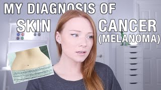 I was Diagnosed with Skin Cancer Melanoma [upl. by Flinn98]