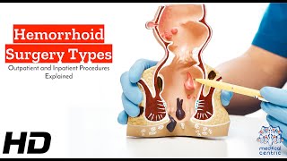 Hemorrhoid Surgery Unveiled Outpatient vs Inpatient – What You Need to Know [upl. by Ecirtaemed710]