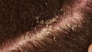 Dandruff Scratching ASMR Scalp Covered in Thick Flakes Dandruff Removal V3 [upl. by Ortiz587]