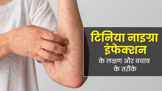 What is Tinea Nigra Fungal Infection  गर्मियों में बढ़ जाता है टिनिया नाइग्रा इंफेक्शन का जोखिम [upl. by Adnoral]