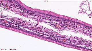 Mucinous Cystadenoma Ovary  Histopathology [upl. by Nayab]