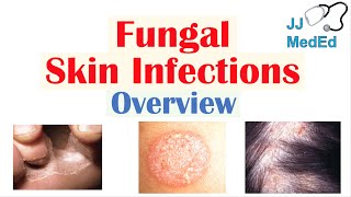 Overview of Fungal Skin Infections  Tinea Infections [upl. by Nylannej]