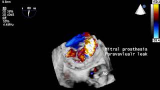 Paravalvular leak of mitral prosthesis by 3D color [upl. by Quinby221]