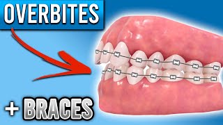 How Do BRACES FIX Overbites  Overbite Before and After Braces  Premier Orthodontics [upl. by Lallage746]