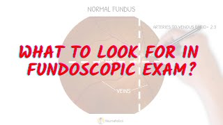 What to look for in fundoscopic exam Neuroaholics [upl. by Nerval]