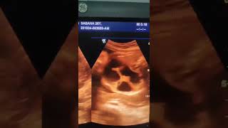 Fetal bowel dilatation Ultrasound shorts video shorts [upl. by Suzann]