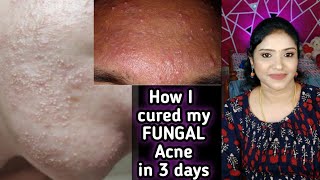 Fungal ACNE Cure  நெற்றியில் பொறி பொறியாக உள்ளதா இதை Try பண்ணுங்க 100 Effective Skincare [upl. by Eilrak]